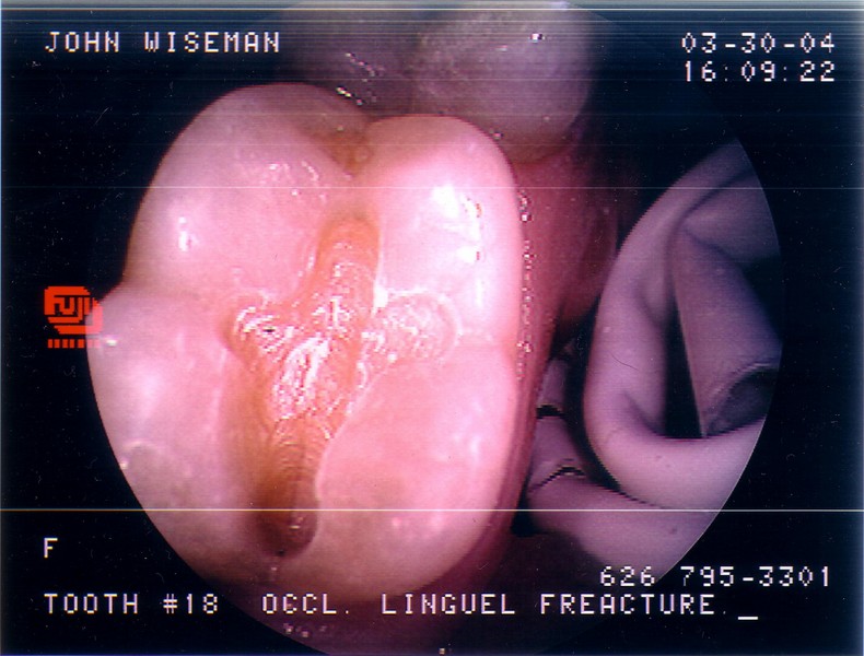 my tooth, with a little cavity and a big crack